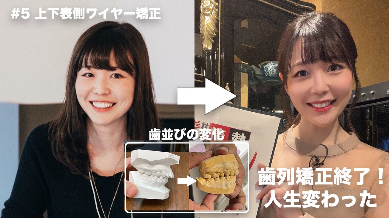 上下表側ワイヤー終了で人生変わった！歯並び変化・痛み・抜歯・よかったこと【#歯列矯正日記 1年経過】 #5