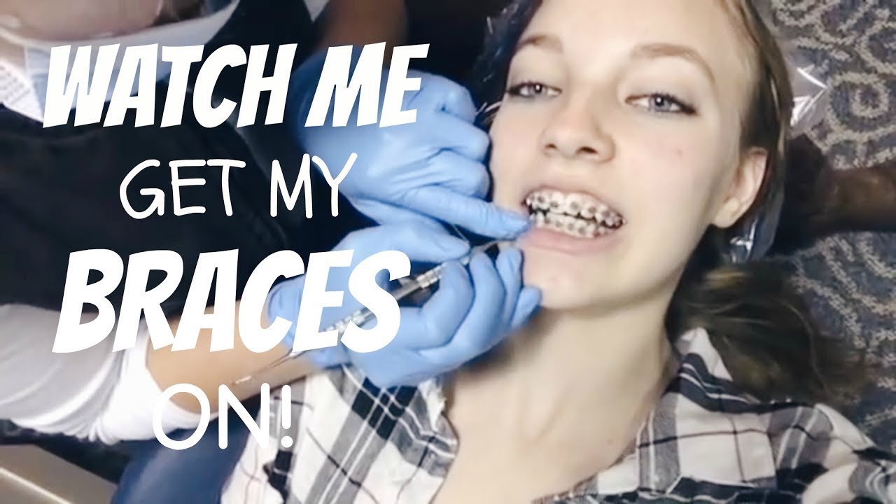 Watch me get my Braces put on!