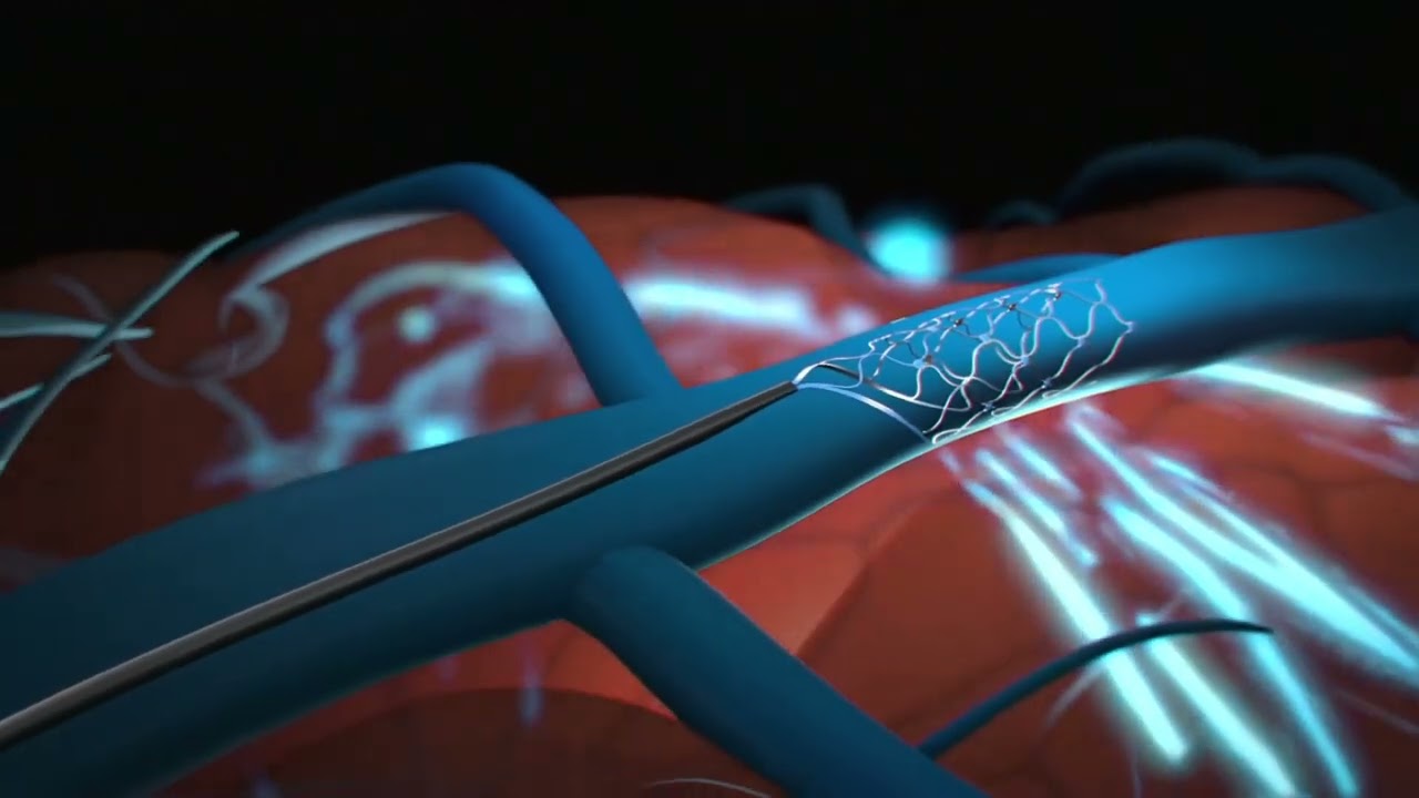 Stentrode Placement Video