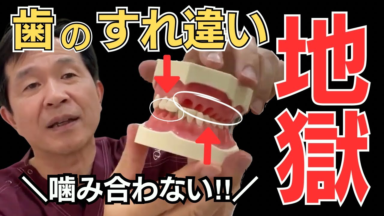【歯が抜けた人、必見‼︎】歯のすれ違いは地獄の始まり　♯すれ違い咬合　♯噛み合わせ