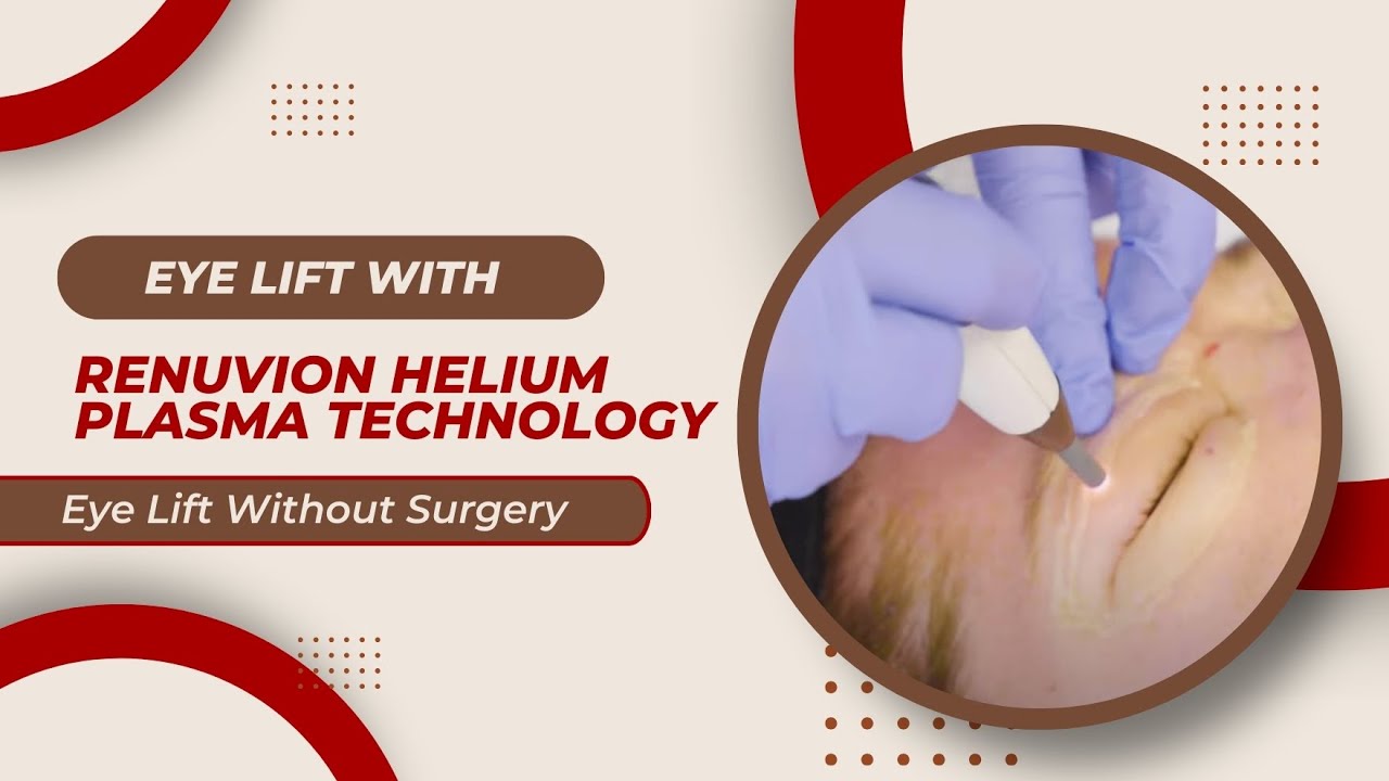 Eye Lift with Renuvion Helium Plasma Technology | Eye Lift Without Surgery by Dr. Jason Emer MD