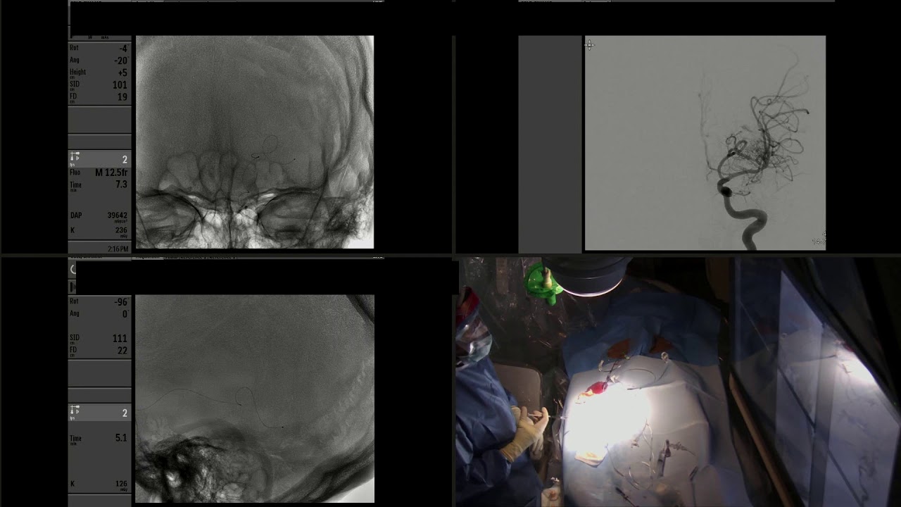 Endovascular embolization with onyx followed by resection of ruptured left parietal AVM