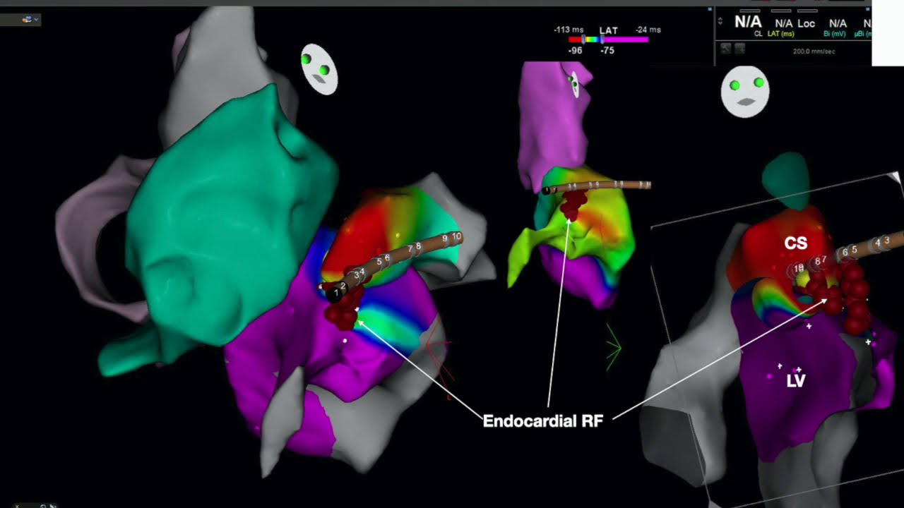 LV Summit Ventricular Arrhythmia Catheter Ablation