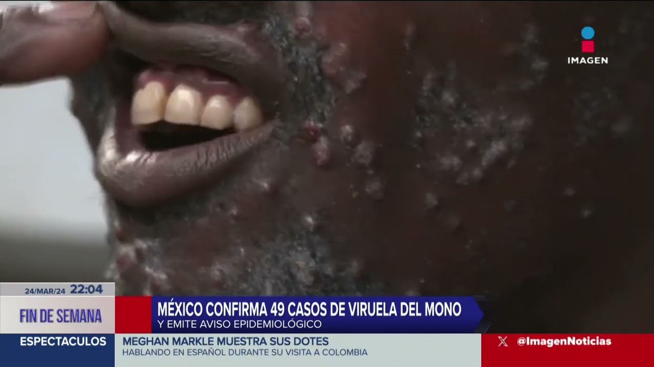 México confirma 49 casos de viruela del mono y emite aviso epidemiológico | Imagen Noticias Fin de
