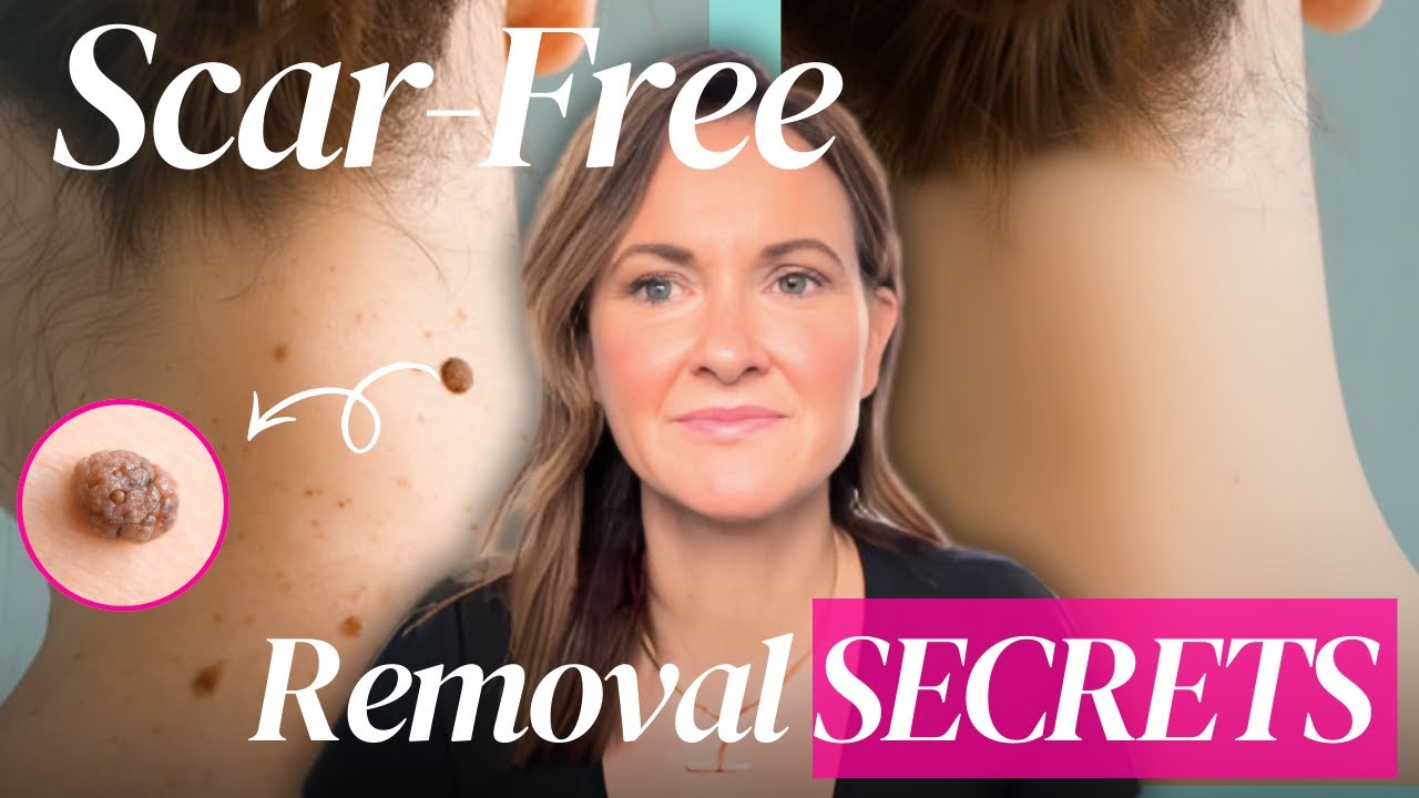 Cosmetic Mole Removal: Expert Techniques for Minimal Scarring | Dr. Jordan Carqueville