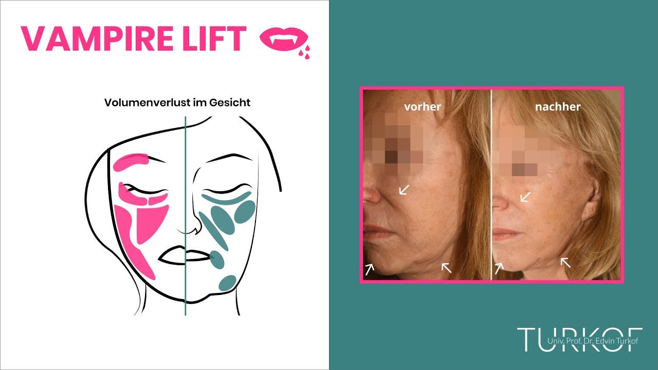 PRP Behandlung (Eigenbluttherapie) - Strahlend frisches Hautbild durch Vampir Lifting