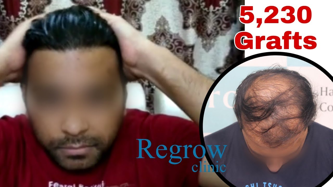 Best Hair Transplant Result 2021 || Diffuse Pattern || 5,230 Grafts ||  @Regrow Clinic ​