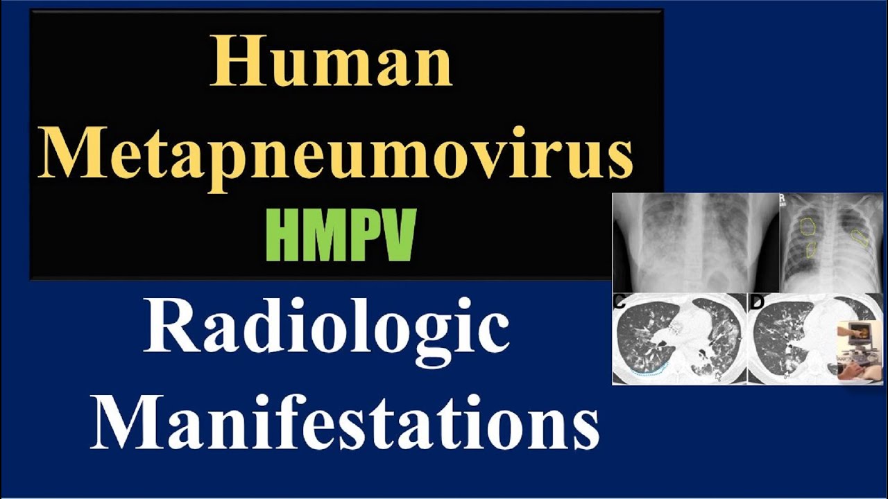 Critical HMPV Radiologic Manifestations You Need to Know in 2025