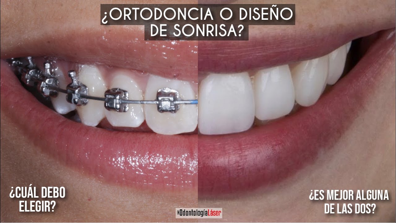 ¿Ortodoncia o Diseño de sonrisa? 🦷 ¿Cuál es mejor? 🤔 - Odontología Láser.