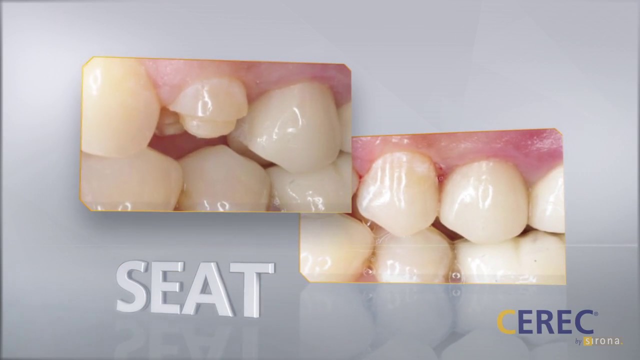 CEREC Omnicam