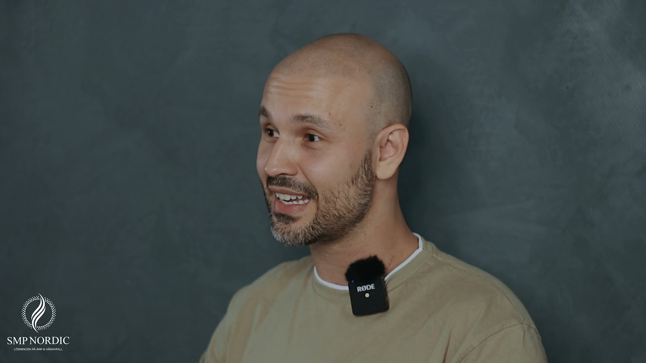 Full treatment scalp micropigmentation