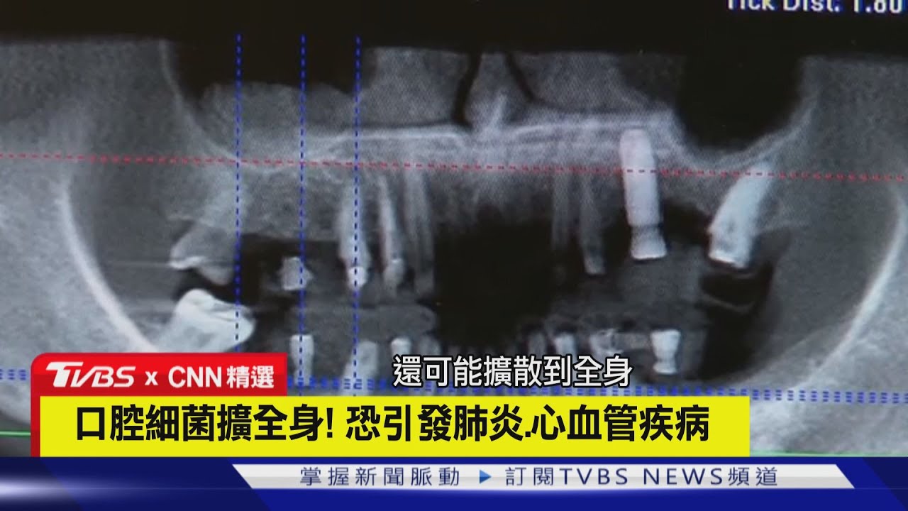 【CNN精選】「口腔保健」比想像重要! 影響呼吸消化系統｜TVBS新聞 @TVBSNEWS01