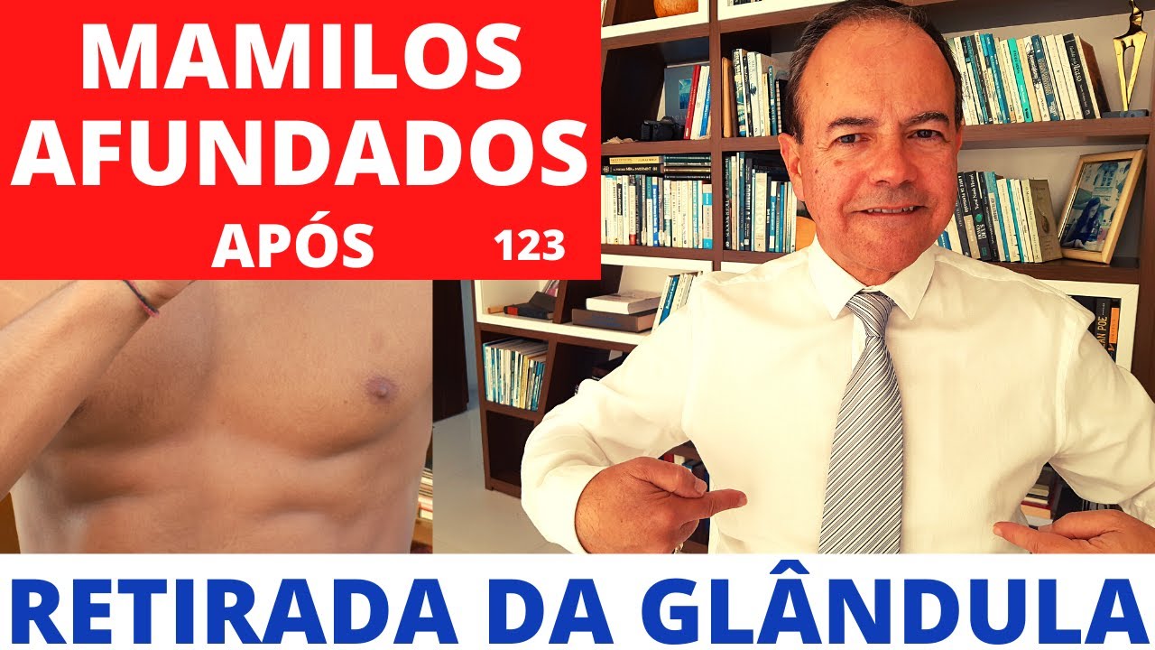GINECOMASTIA -  Mamilos afundados após a retirada da glândula toda [Cirurgia Plástica]