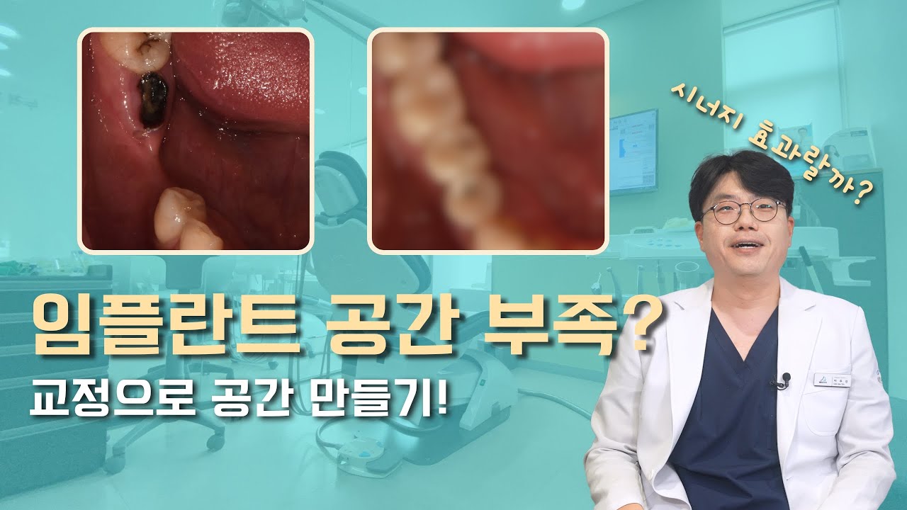임플란트 심을 공간이 부족하다면? 치아교정으로 해결하는 법!