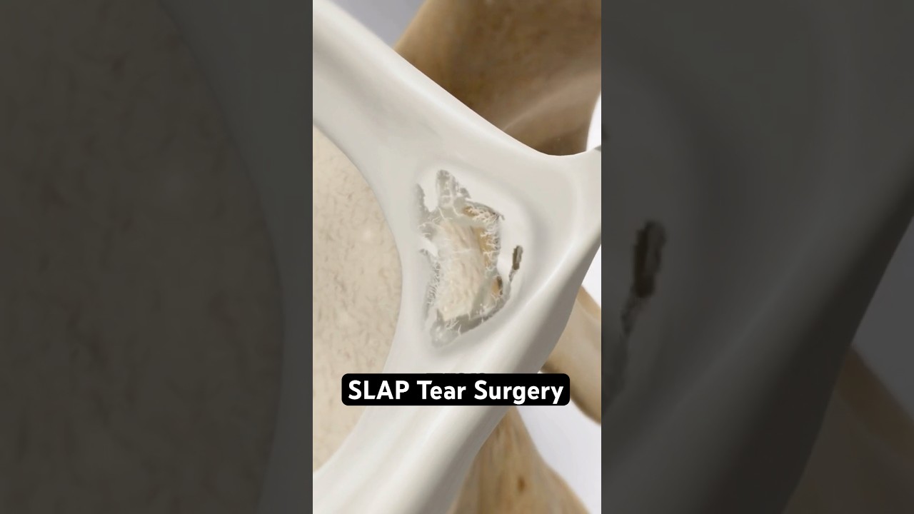 Хирургия разрыва SLAP (3D-анимация)