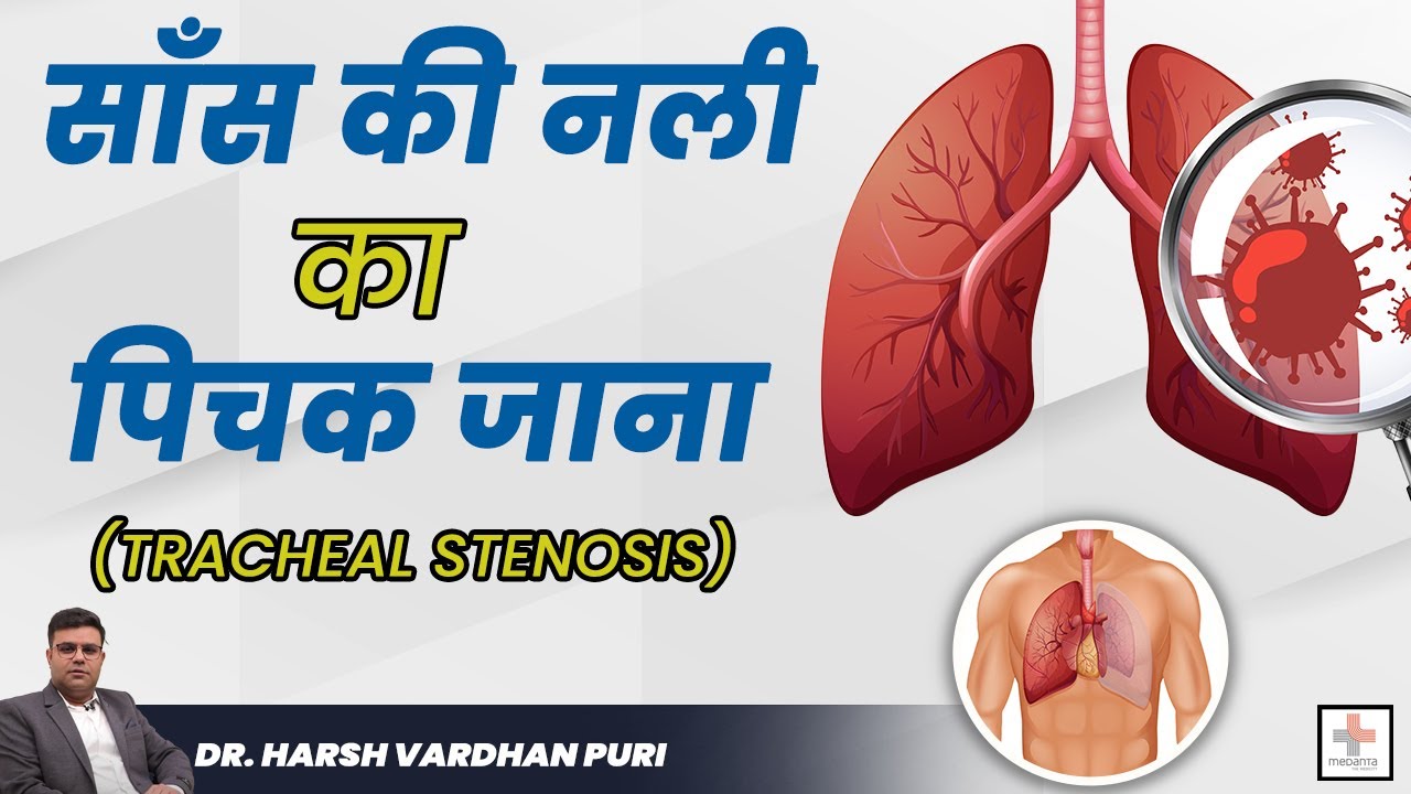 साँस की नली का सिकुड़ना (Tracheal Stenosis) | Video-Assisted Thoracic Surgery (VATS) Delhi NCR