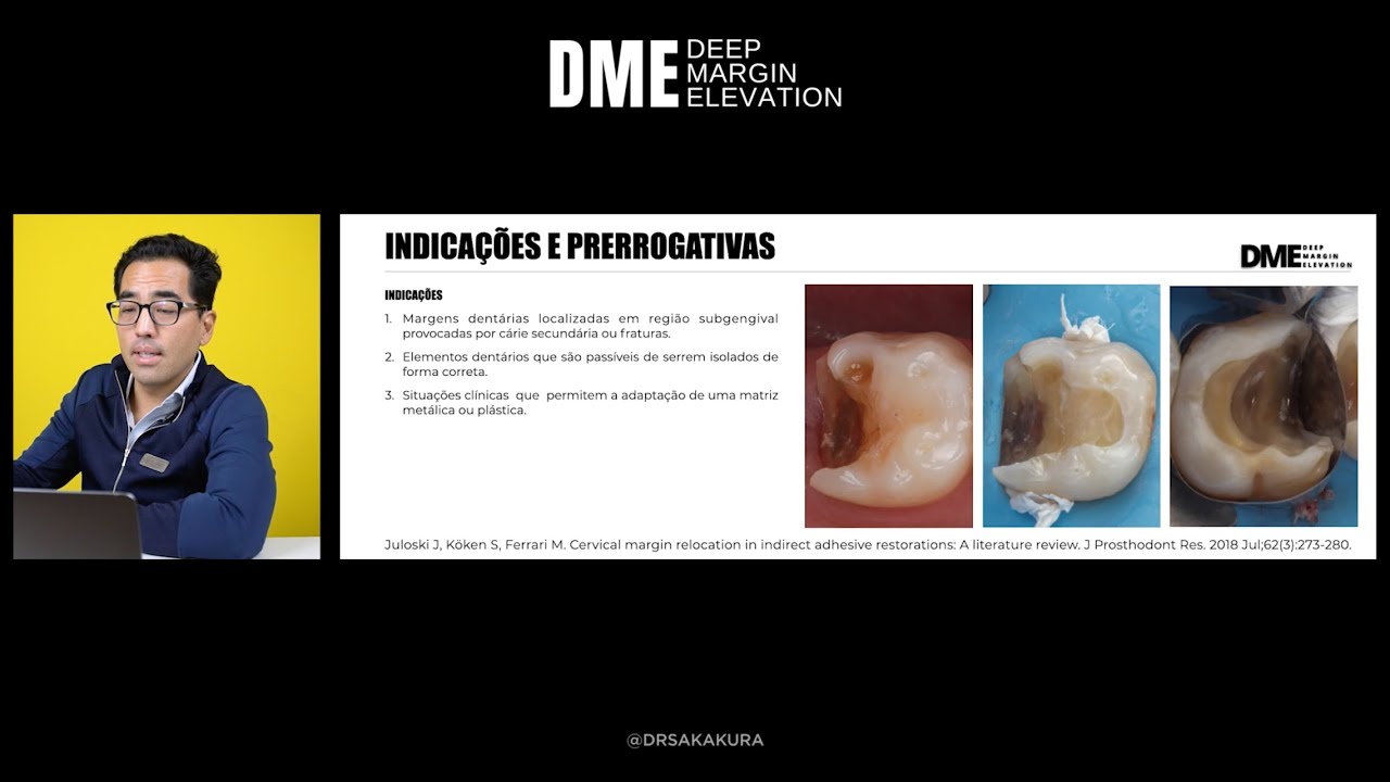 DME Deep Margin Elevation - Aula sobre elevação de margem gengival