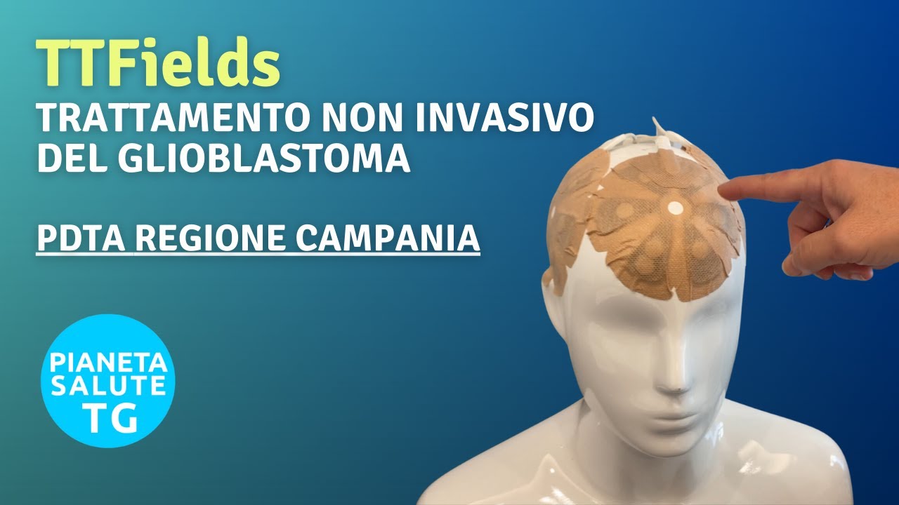 TTFields: L'arma segreta per combattere il glioblastoma