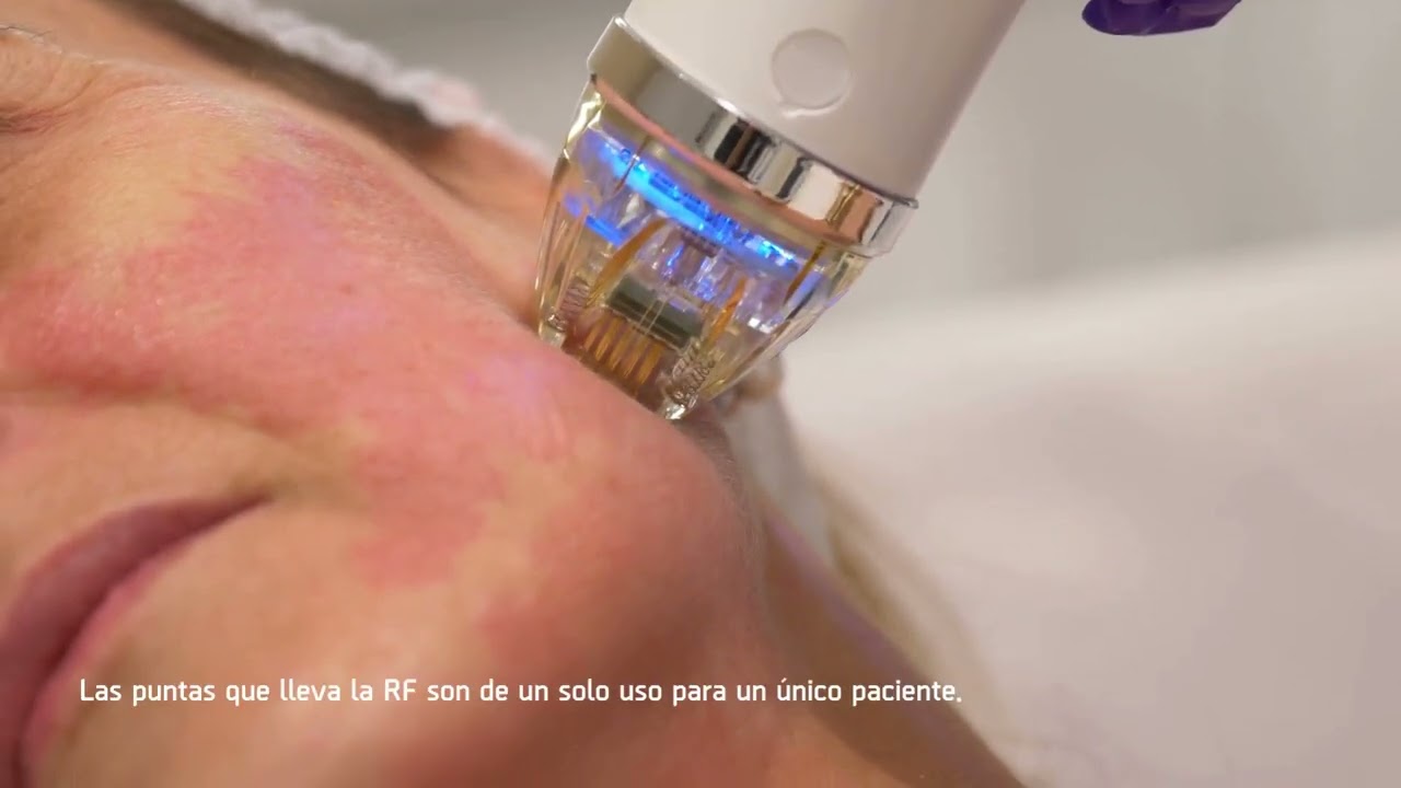 Didac Barco - Rejuvenecimiento facial con radiofrecuencia fraccionada bipolar de agujas