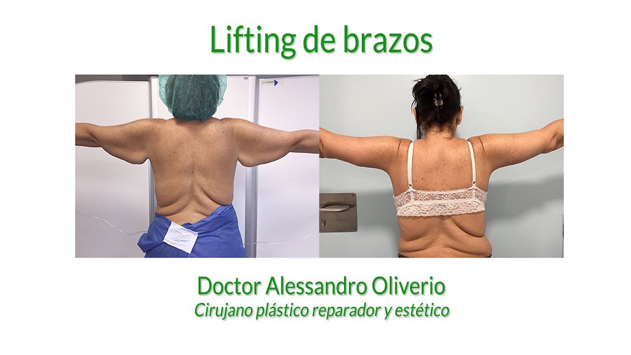Lifting de brazos - Doctor Oliverio, jefe di Cirugia Plastica