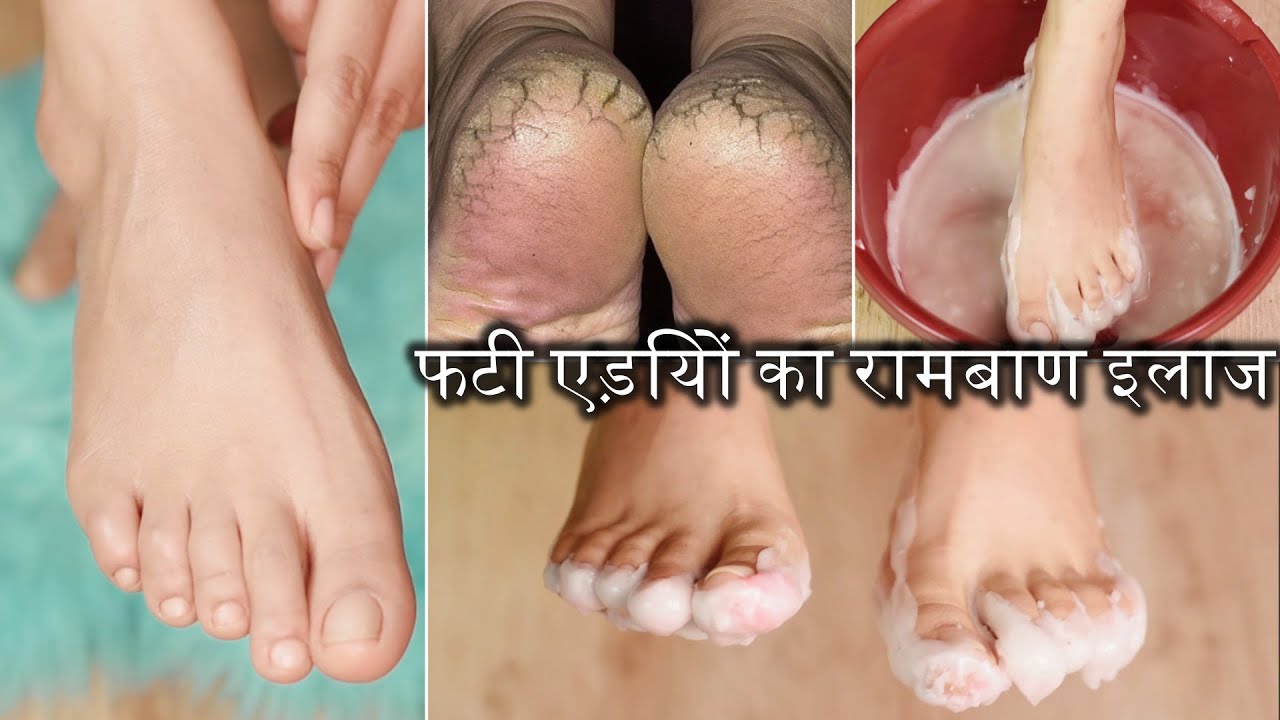 पैरों का ऐसे करें देखभाल फटी एड़ियों /Cracked Heels का रामबाण इलाज Pedicure- clean smooth bright feet