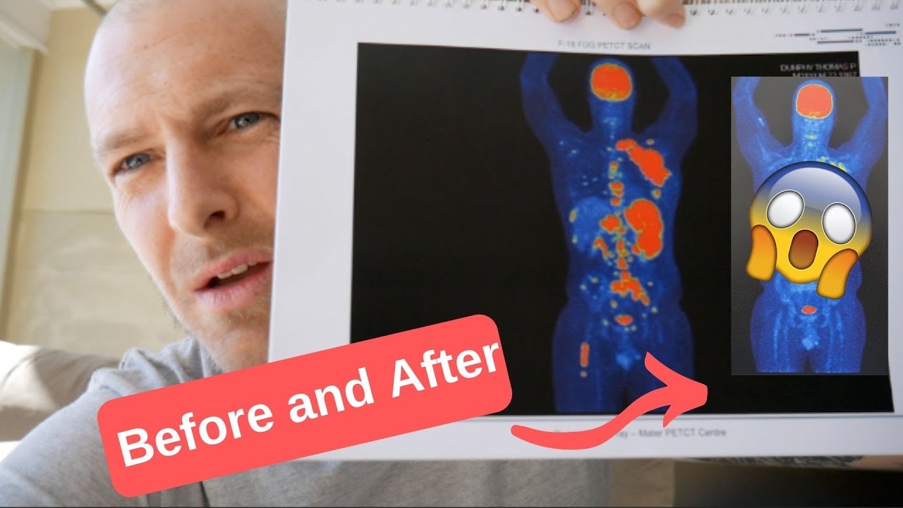 What does Lymphoma look like on a Pet Scan? Before and After Chemo!