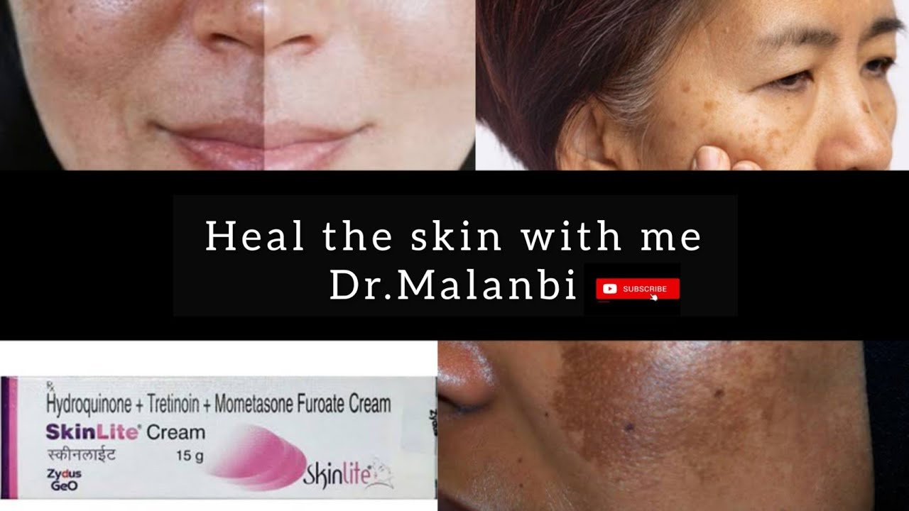 How To Use Skinlite Cream ||Benefits Sideeffect || English ||  ||Dr Malanbi || Hydroquinone Tretinon