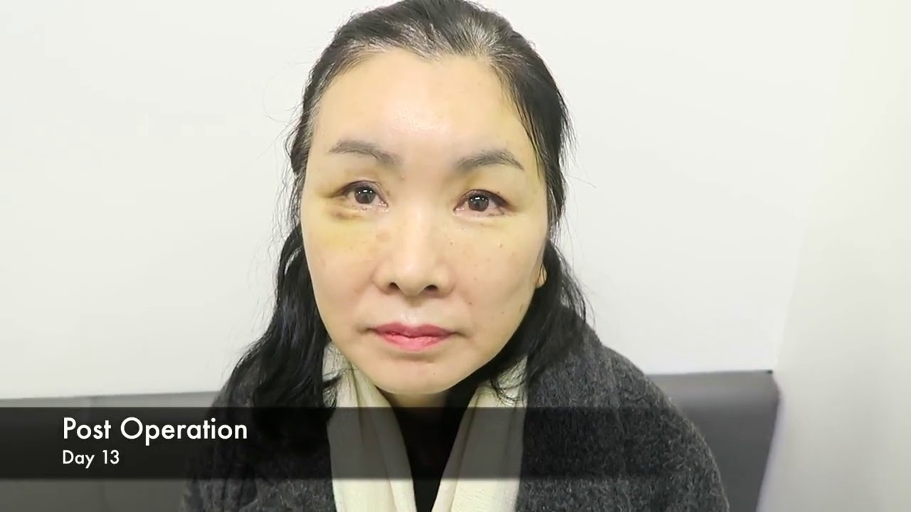 Post-Operative treatment Ibunya Sunny Dahye di Klinik BANOBAGI! -Part 2