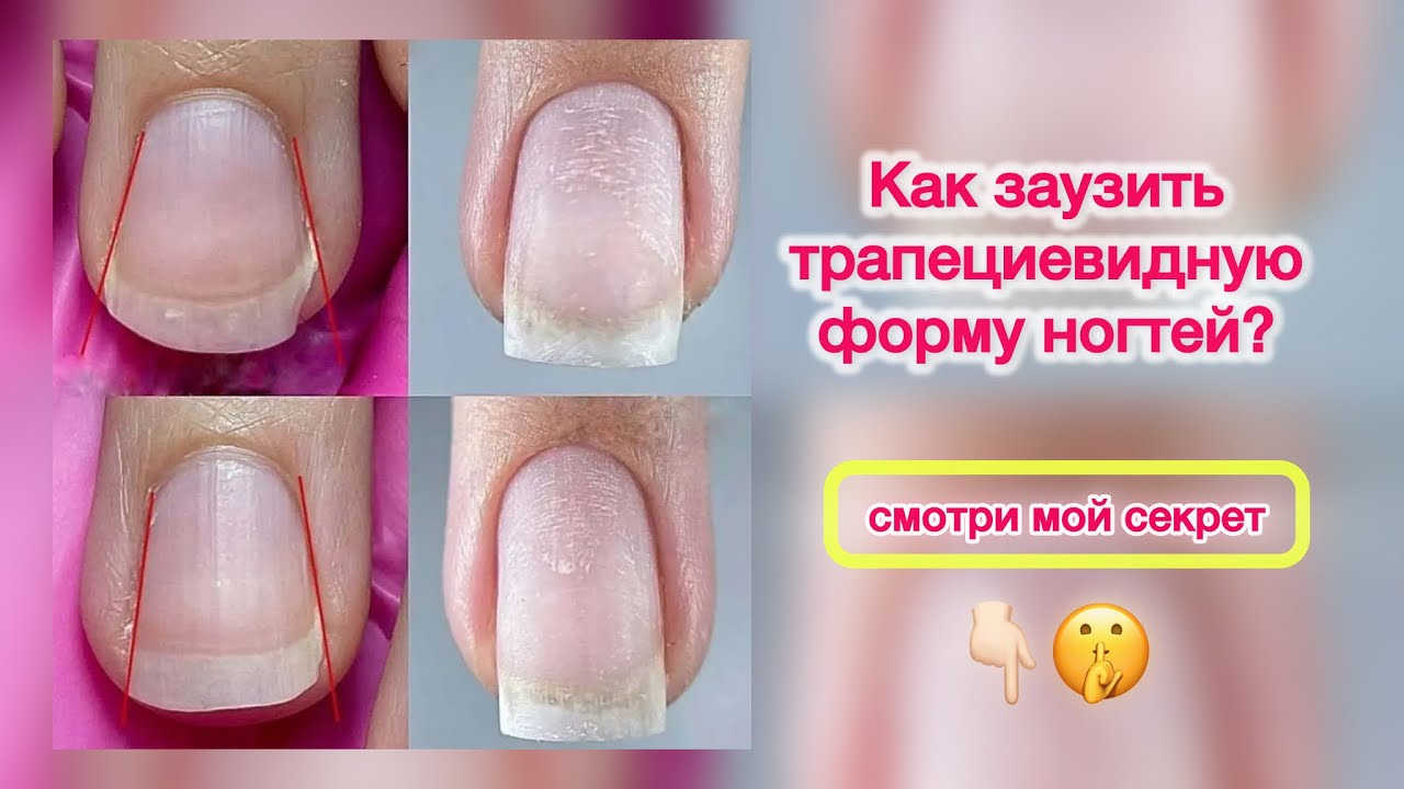 Сужаем трапециевидную форму ногтей. Заужение ногтей. Широкие ногти,что делать? Почему ногти широкие?
