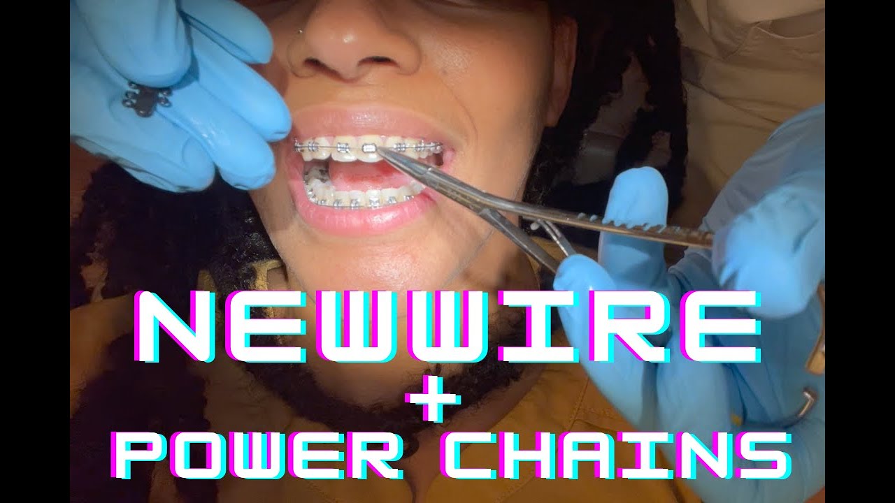 Braces Vlog  Month five and six update | New Wire & Power Chains!