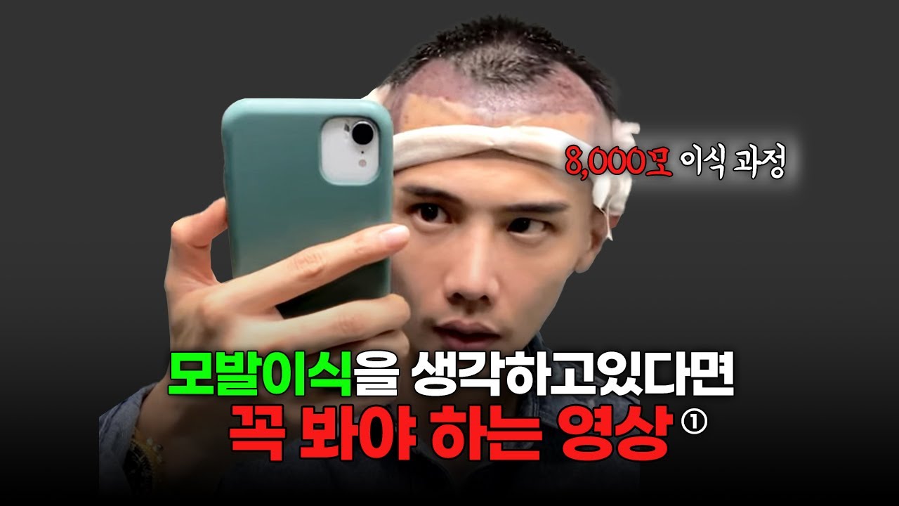 내돈내산 리얼 모발이식 후기