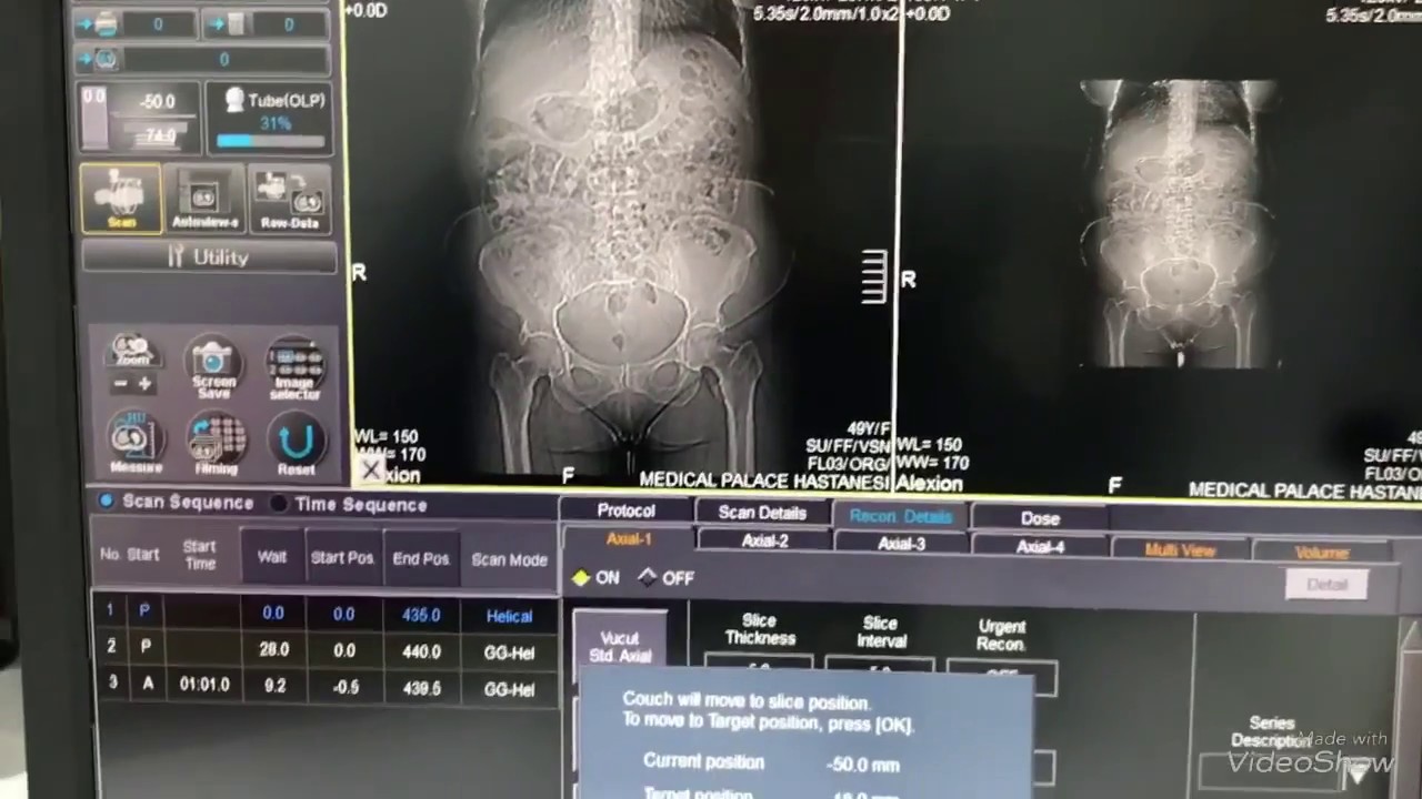 3 Faz Oral+İV Kontrastli Tüm Abdomen CT Nasil Cekilir? Multifazik Tomografi Çekmeyi Öğreniyorum.