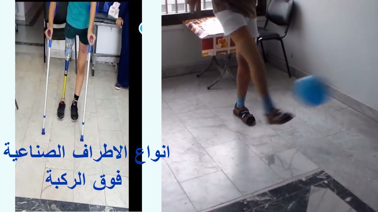 احدث انواع الاطراف الصناعية فوق الركبة الالمانية - انواع الركبة المتحركة و الثابتة - الفضل ميديكال