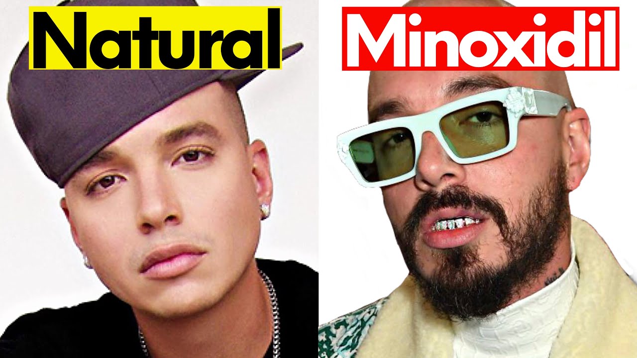 La Barba de J Balvin es de Minoxidil o Natural