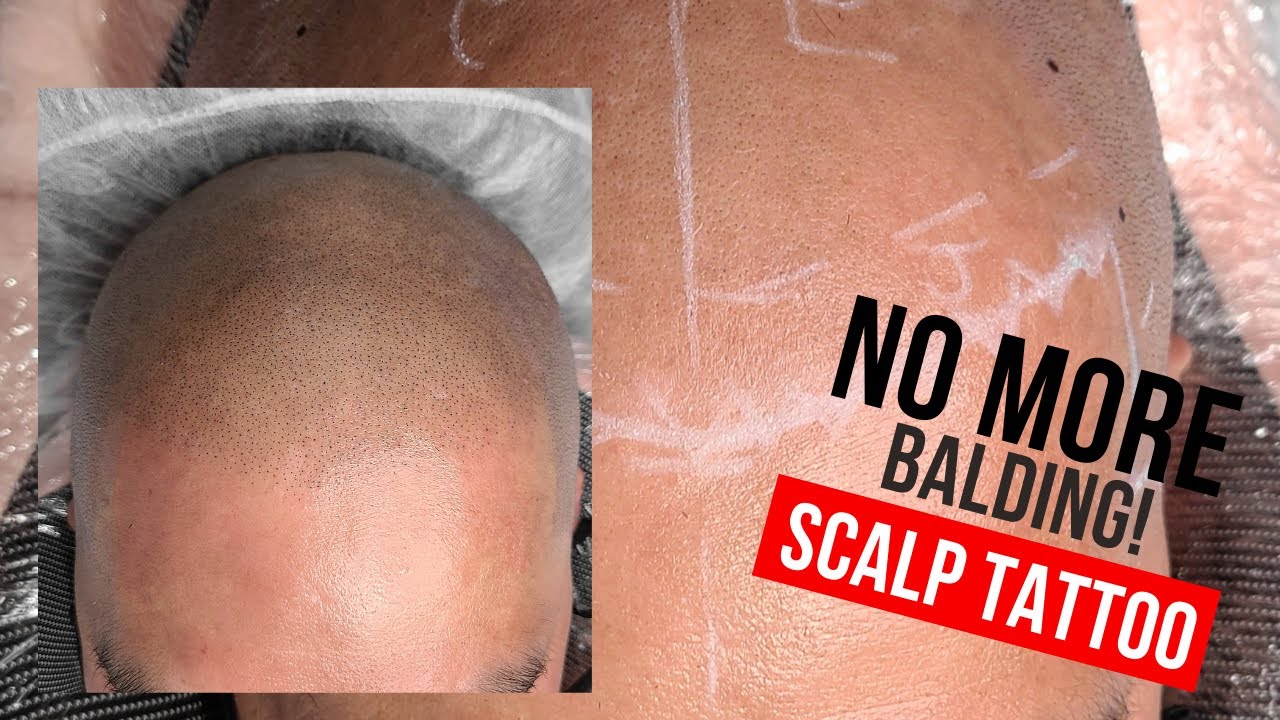 Scalp Micropigmentation Flawless SMP Vancouver Behind the Scenes of a Hair Loss Treament Full Hair