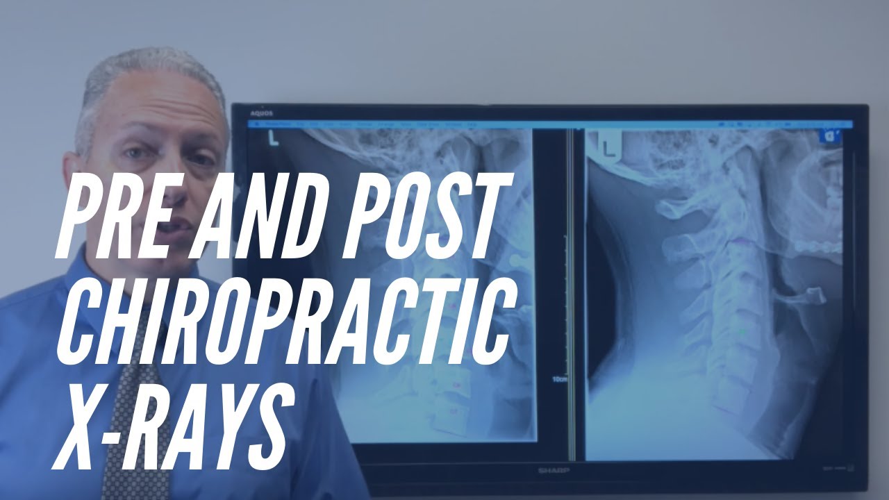 Pre and Post X-rays Show Improvement With Chiropractic Care - Houston Chiropractor
