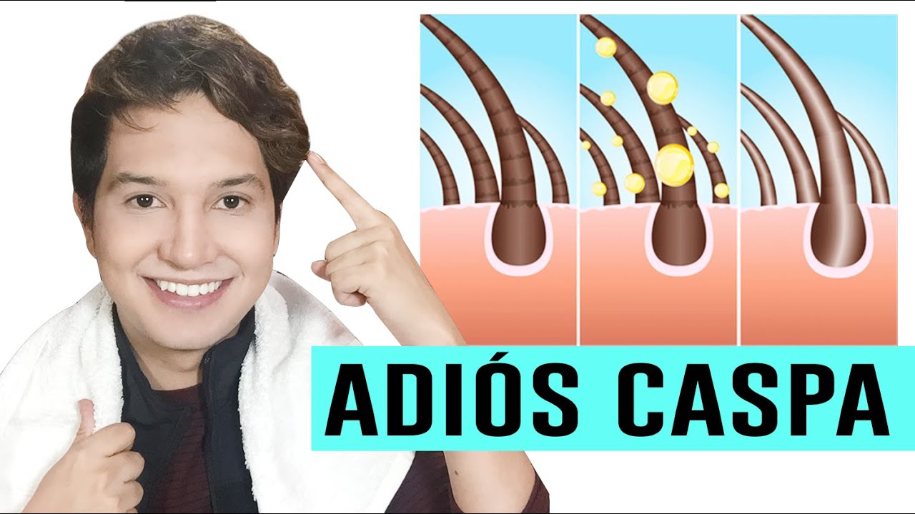 COMO ELIMINAR LA CASPA NATURALMENTE CON REMEDIOS CASEROS | Vinagre Blanco | Andy Zaturno