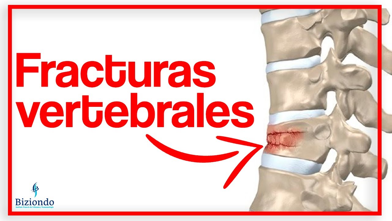 😖 Aplastamiento de vertebras en la columna: &iquest;Qu&eacute; son? &iquest;C&oacute;mo tratarlos? | Biziondo