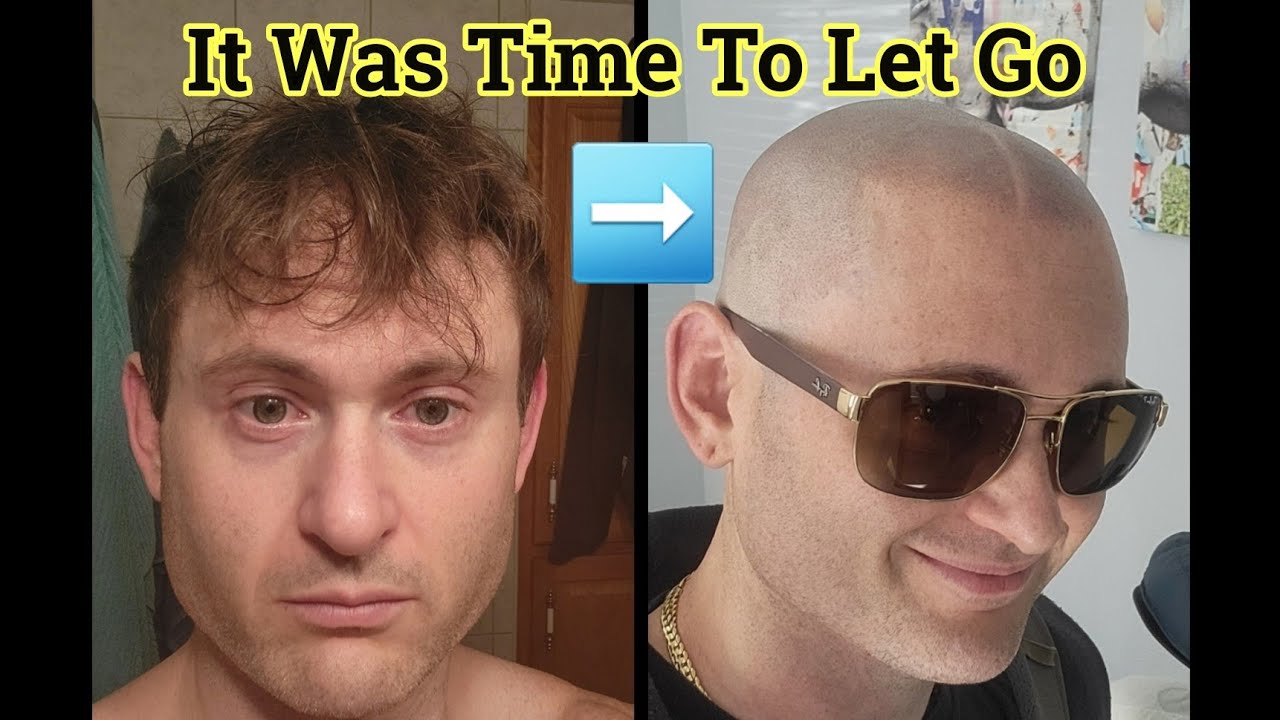 Everything Scalp Micropigmentation | SMP