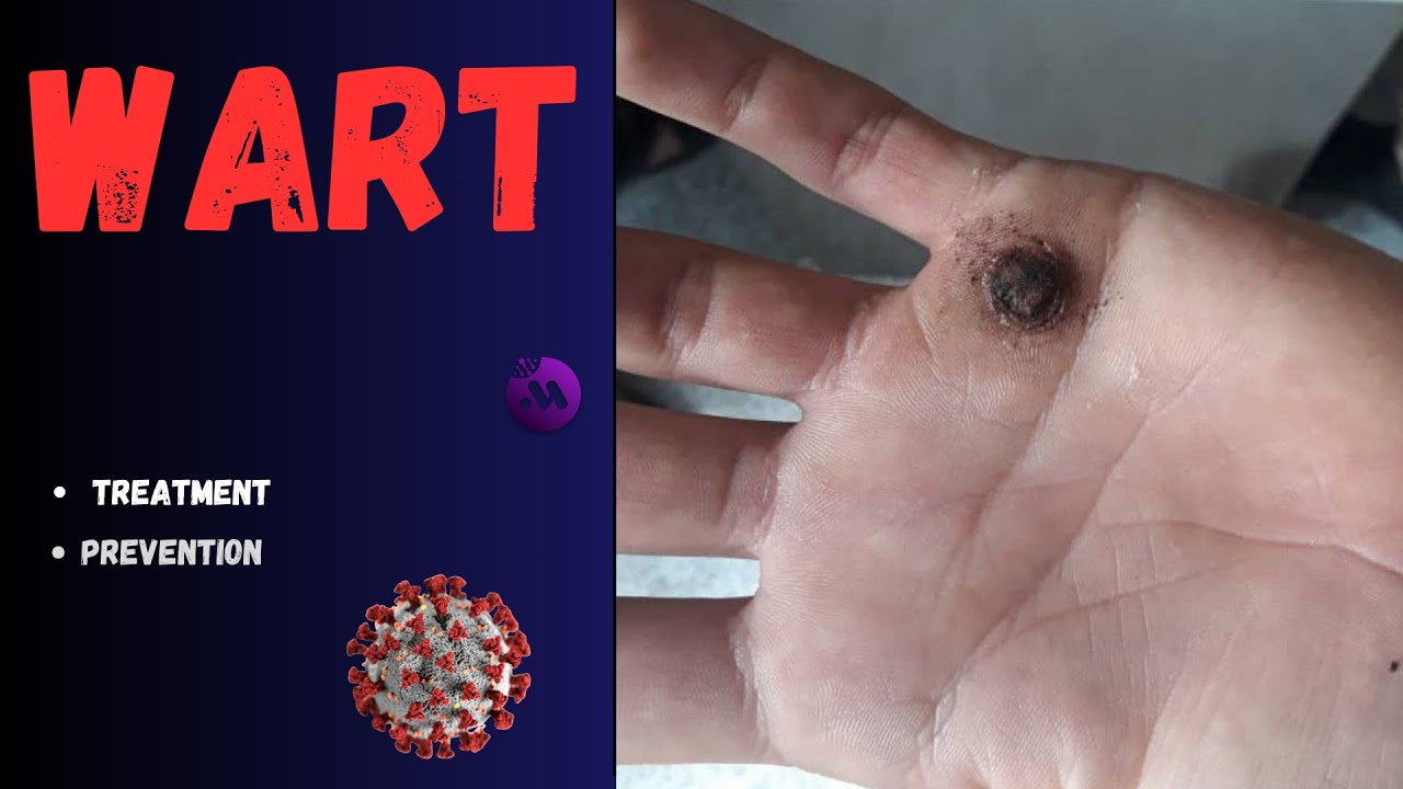 Wart - All types with pictures - Treatment and prevention