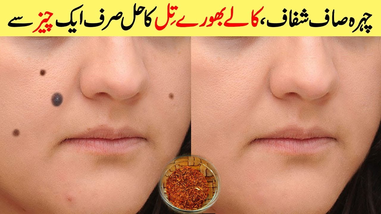 1 Home Remedy for All, Black Spots, Pigmentation, Brown Spots, Moles, Discoloration Urdu Hindi