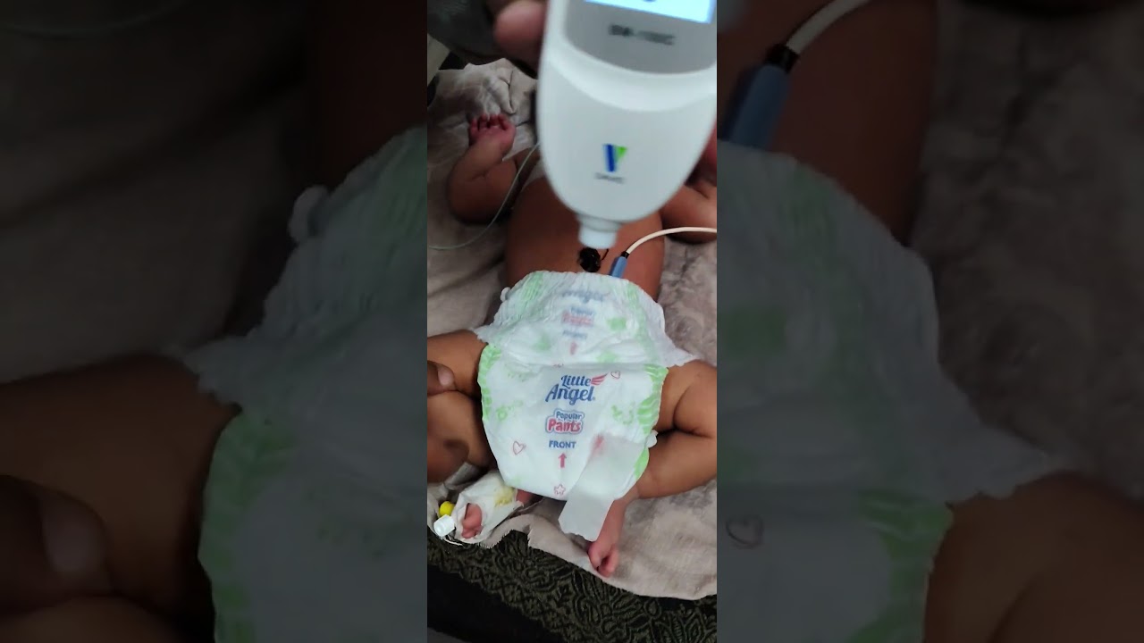 bilirubin level by transcutaneous bilirubinometer