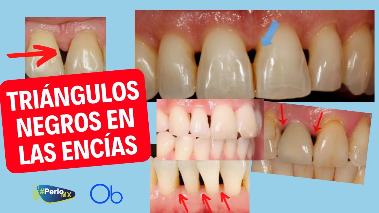 ¿Qué es la PAPILA INTERDENTAL y por qué se pierde? 🦷 ▲ triángulos negros en la encía con @PerioMX