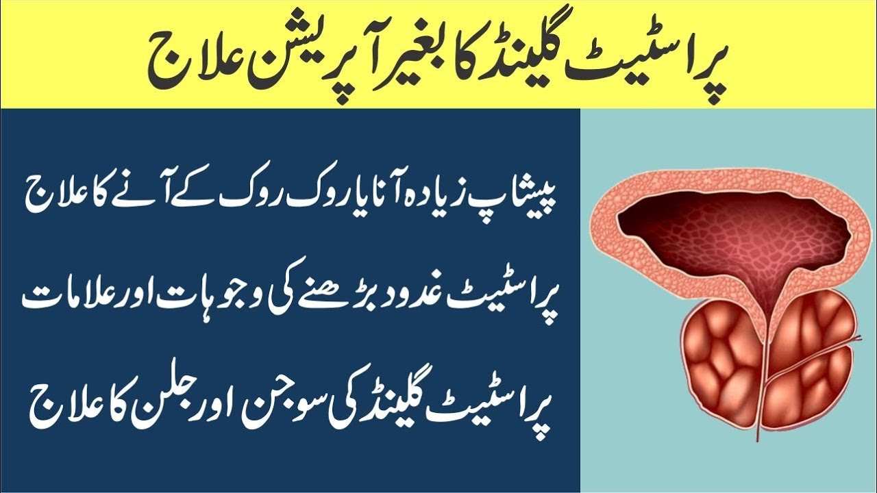 Prostate gland ka ilaj in urdu | Prostate Treatment in urdu | Dr Jahangir Yasir