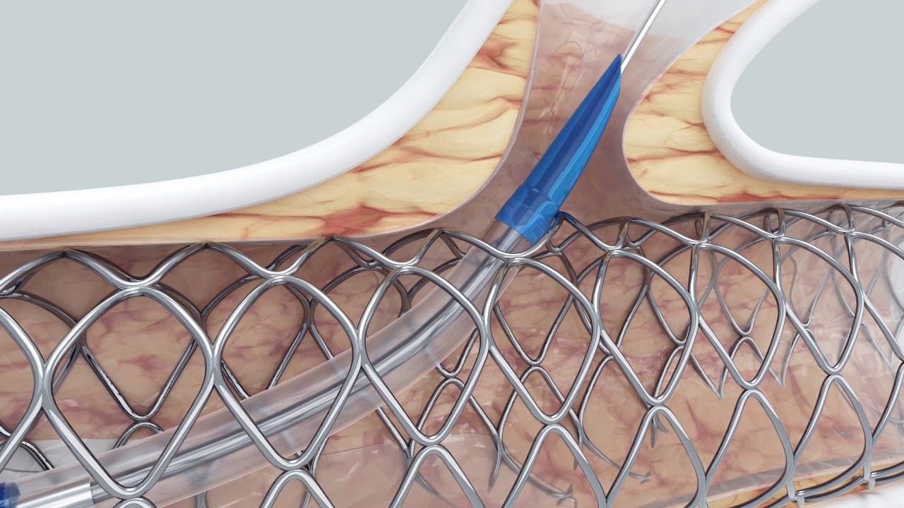 Glider™ PTCA Balloon Catheter