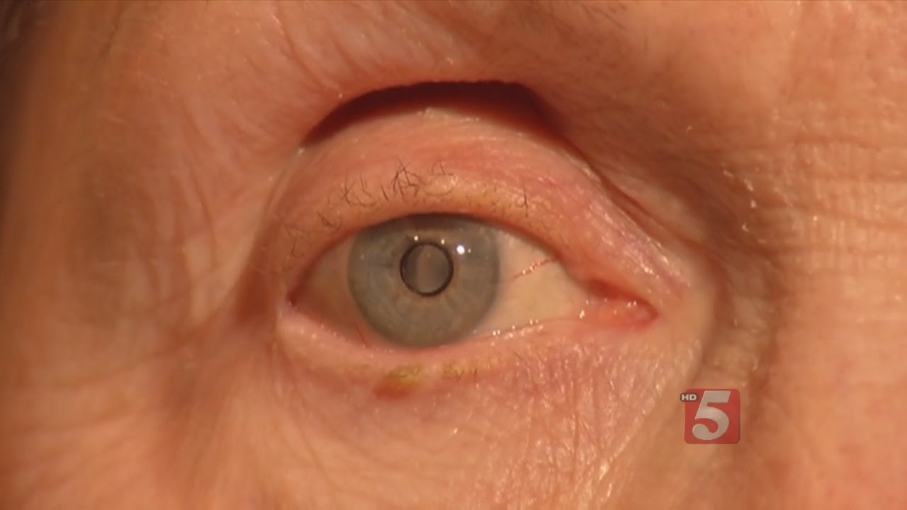 Eye Telescope For Macular Degeneration