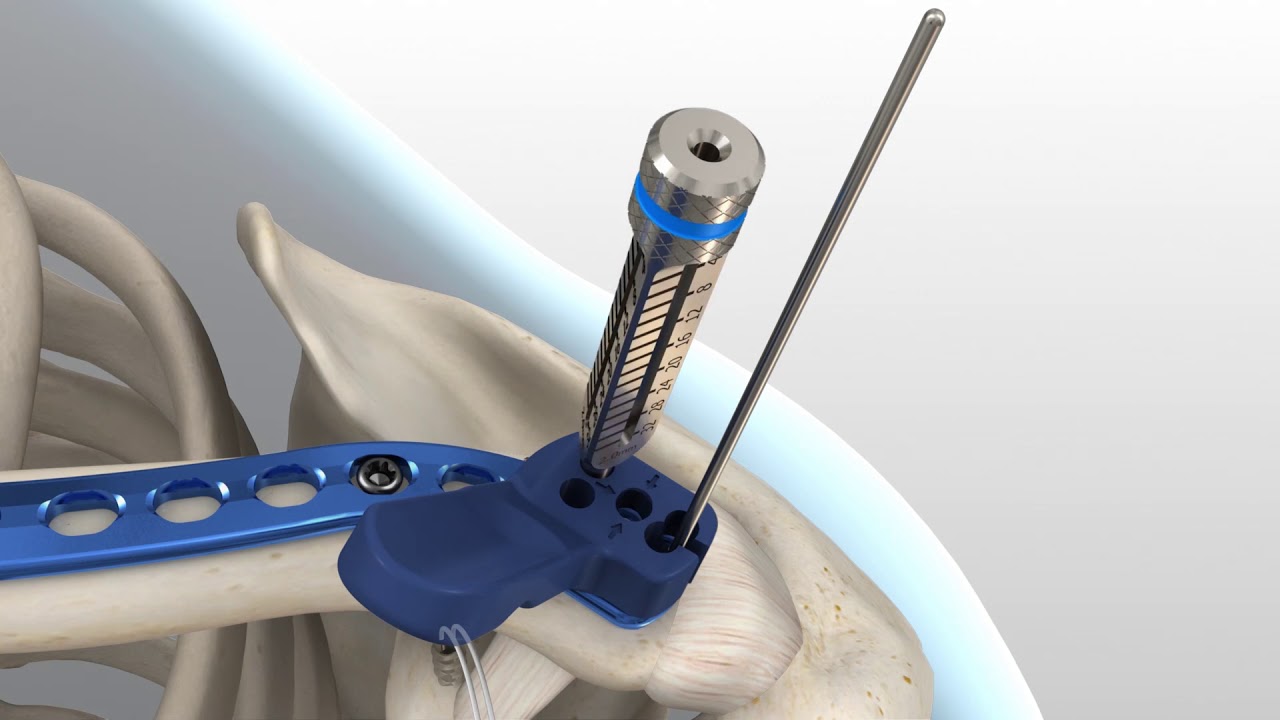 Acumed - Acu-Sinch Surgical Technique Animation - Pulse 3D Media