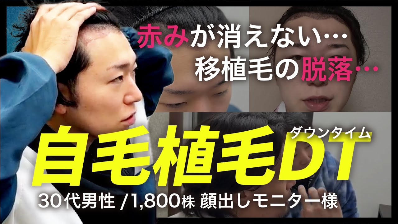 【毎日経過】自毛植毛の術後ダウンタイムレポ！移植毛の脱落は異常？