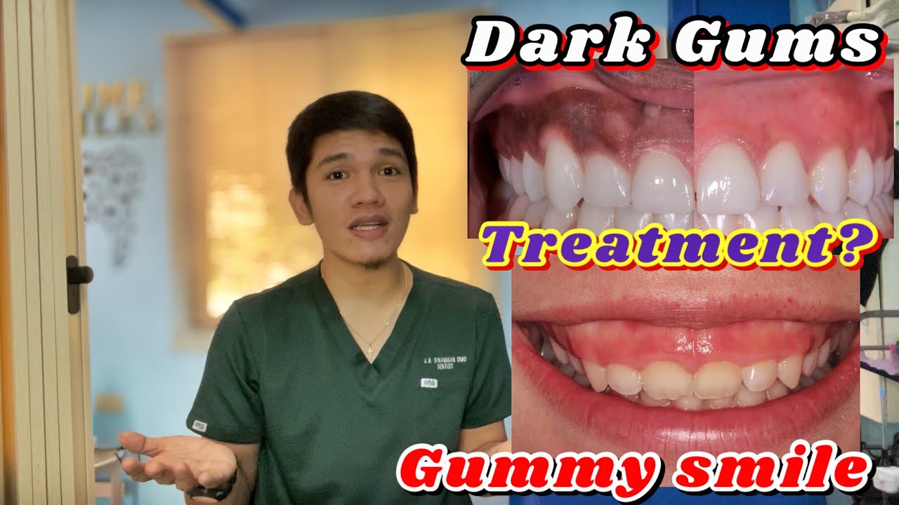 GUMMY SMILE, DARK GUMS and UNEVEN TEETH: Treaments (Gingivectomy, Gum Bleaching and Enameloplasty)