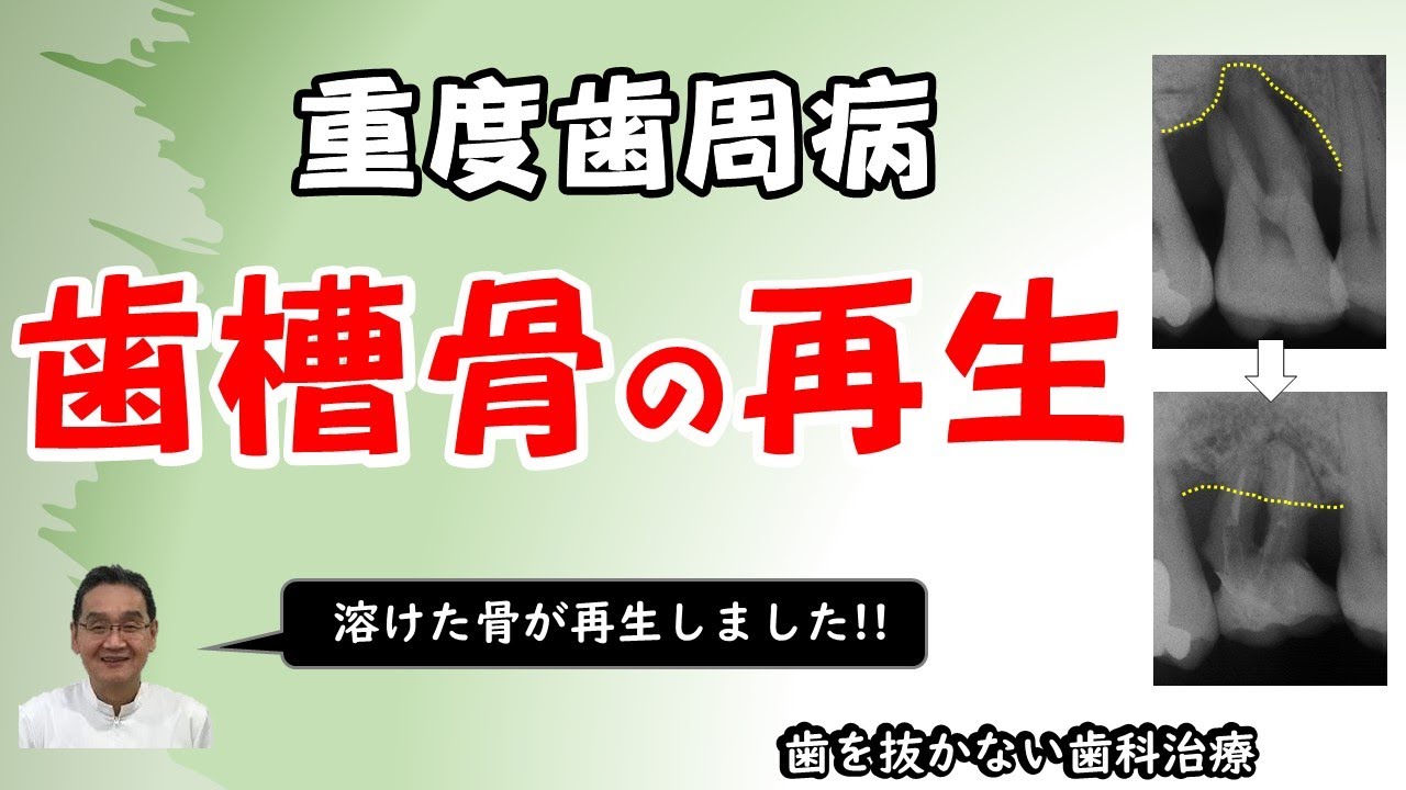 重度歯周病で溶けた骨も再生します。あわてて抜歯しないでください。